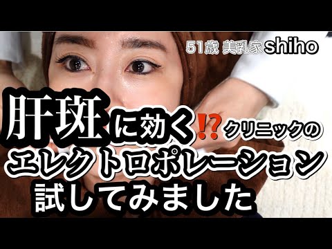 肝斑に効く⁉️クリニックのエレクトロポレーション、メソナJを試してみた‼️