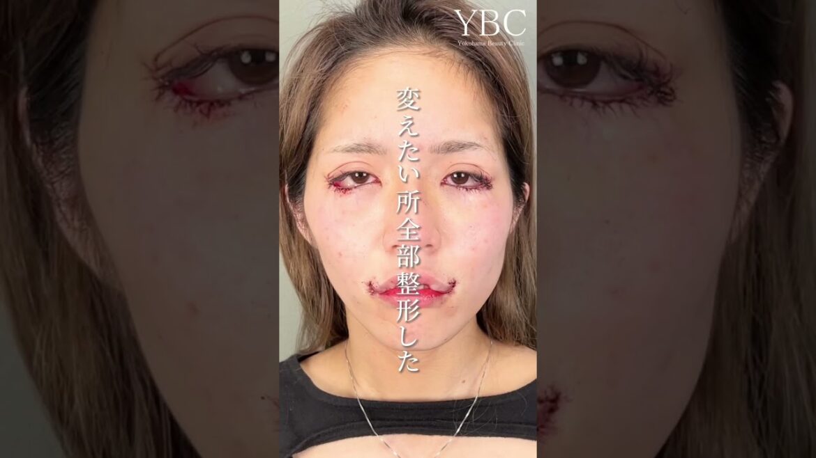 【美容整形】ずっと自分の顔が嫌だった【口角挙上】 #shorts