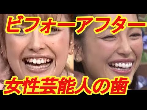 安室奈美恵も?!こんなに変わる!歯並びが綺麗に整った女性芸能人ビフォーアフター 【芸能デスク】before→after