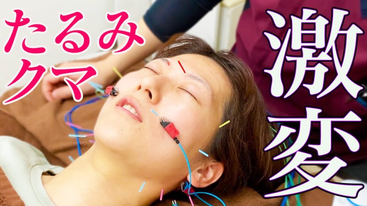 【美容鍼 効果】美容鍼効果で視聴者さんのお悩み速攻解決!?@hitopoppo
