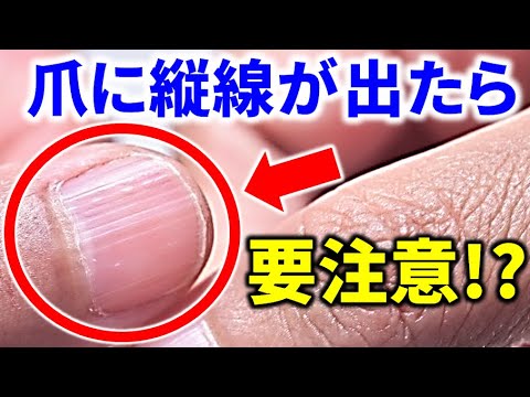 【爪でわかる!】爪に縦線が出たら要注意!?爪でわかるあなたの健康