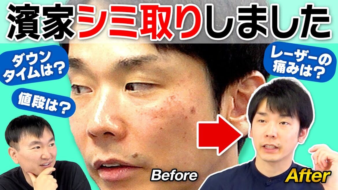 【シミ取り】かまいたち濱家が顔のシミ取りをした件について話します
