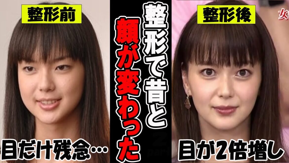 【がるちゃん芸能人】整形で昔と顔が変わった芸能人 衝撃のビフォーアフター!