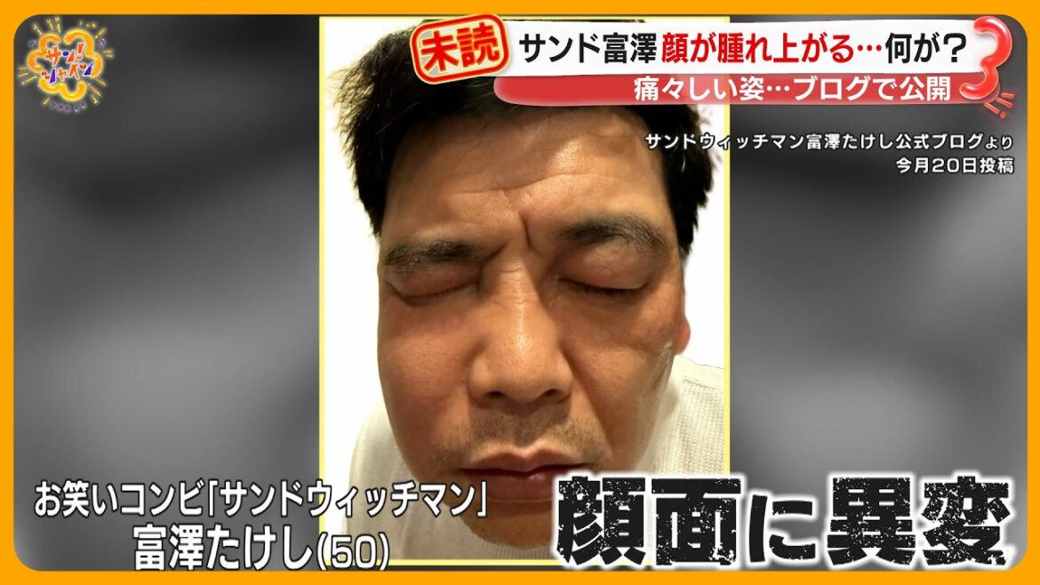 サンドウィッチマン富澤 (50) 副鼻腔炎で顔がパンパンに腫れ…ブログで公開 医師 「特にこの時期に注意」【サン!シャインニュース】
