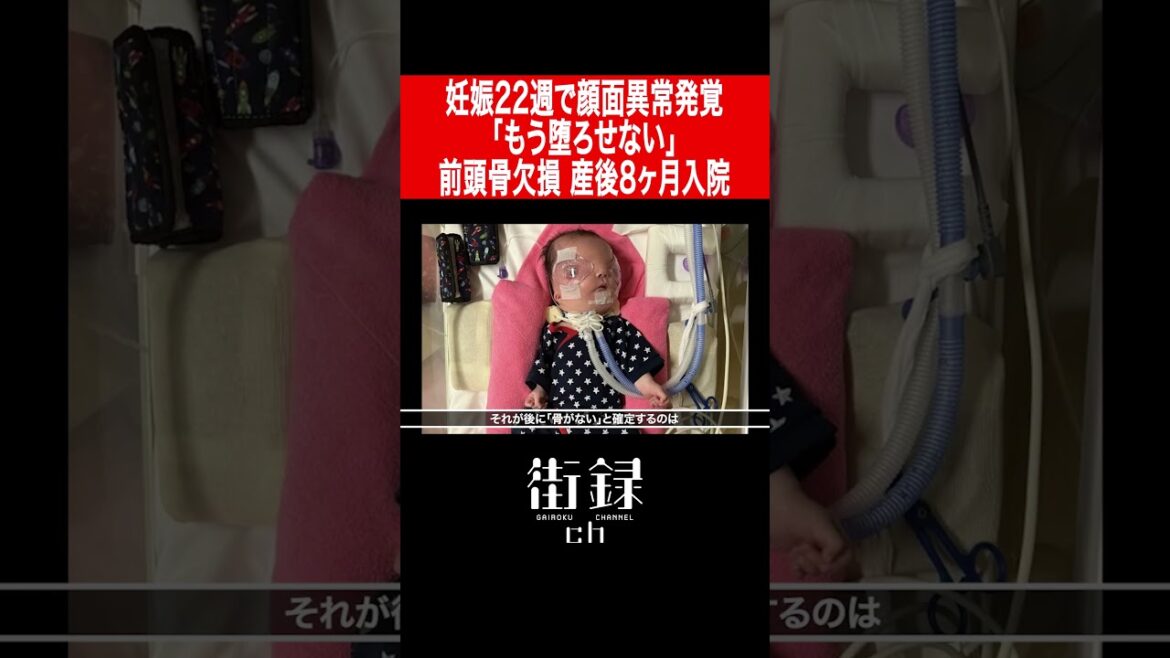 妊娠22週で顔面異常発覚も「堕ろせない」/前頭骨欠損 産後8ヶ月入院/星のミライChannel