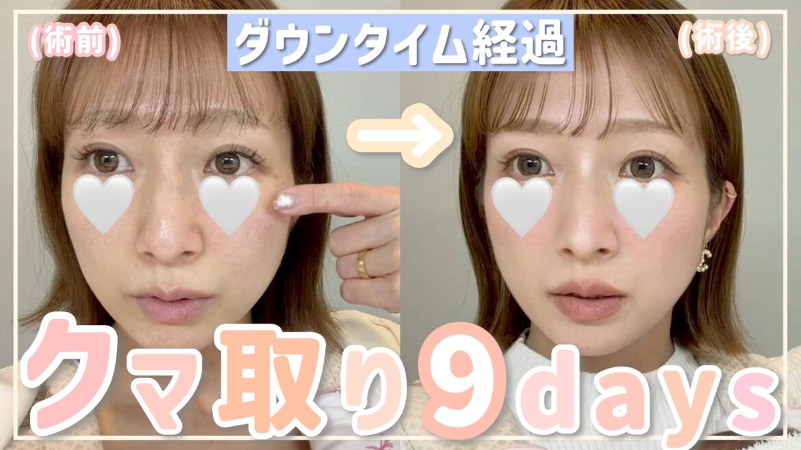 【クマ取り】術前〜術後のダウンタイム9日間の記録📝